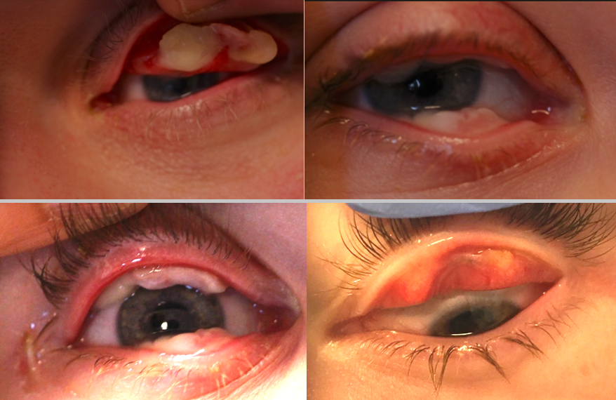 Ligneous Conjunctivitis